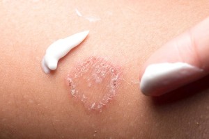 Dị ứng da: Loại nào? Xử lý nhanh chóng