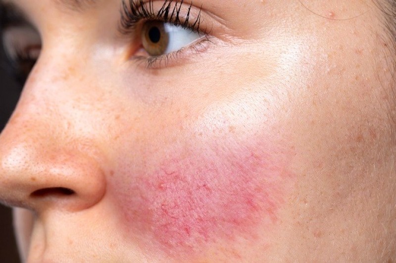 Tretinoin trị mụn: Hiệu quả và lưu ý khi sử dụng