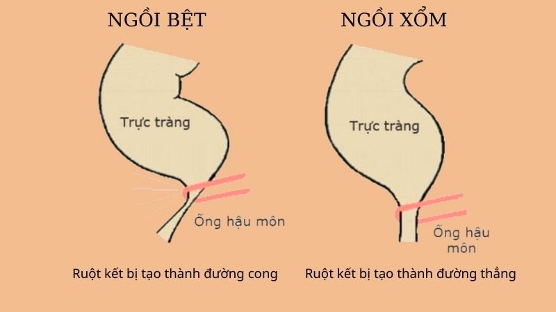 Cách ngồi toilet đúng