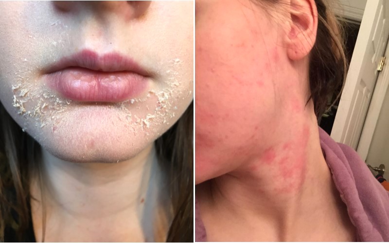 Tác dụng phụ khi dùng Tretinoin