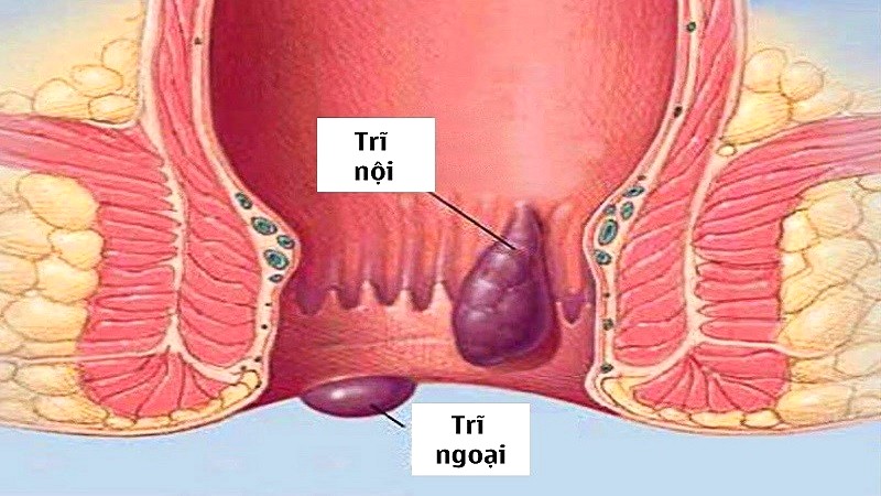 Giảm triệu chứng bệnh trĩ.