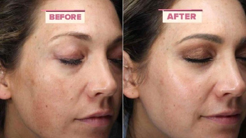 Mụn nào dùng retinol/tretinoin?