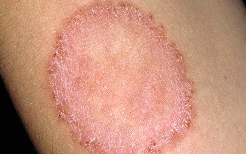 Nấm da: Gánh nặng sức khỏe và tinh thần.