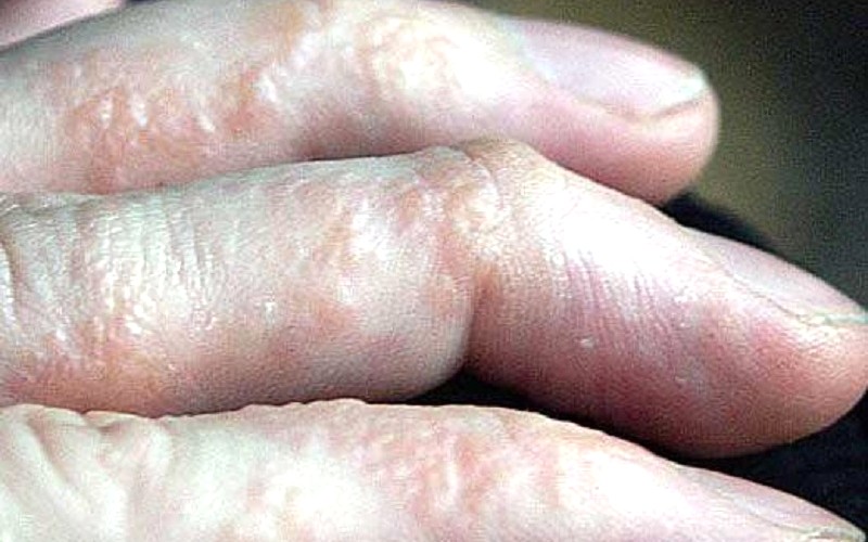 Bệnh tổ đỉa trên da tay