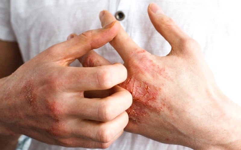 Nhiễm khuẩn do chàm da gây ra